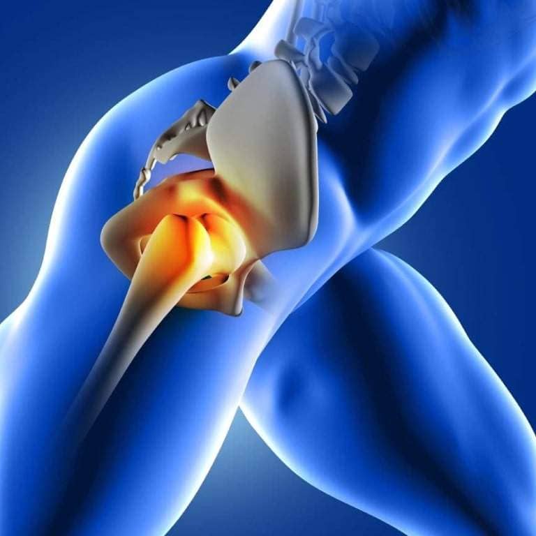 Dolor trocantereo